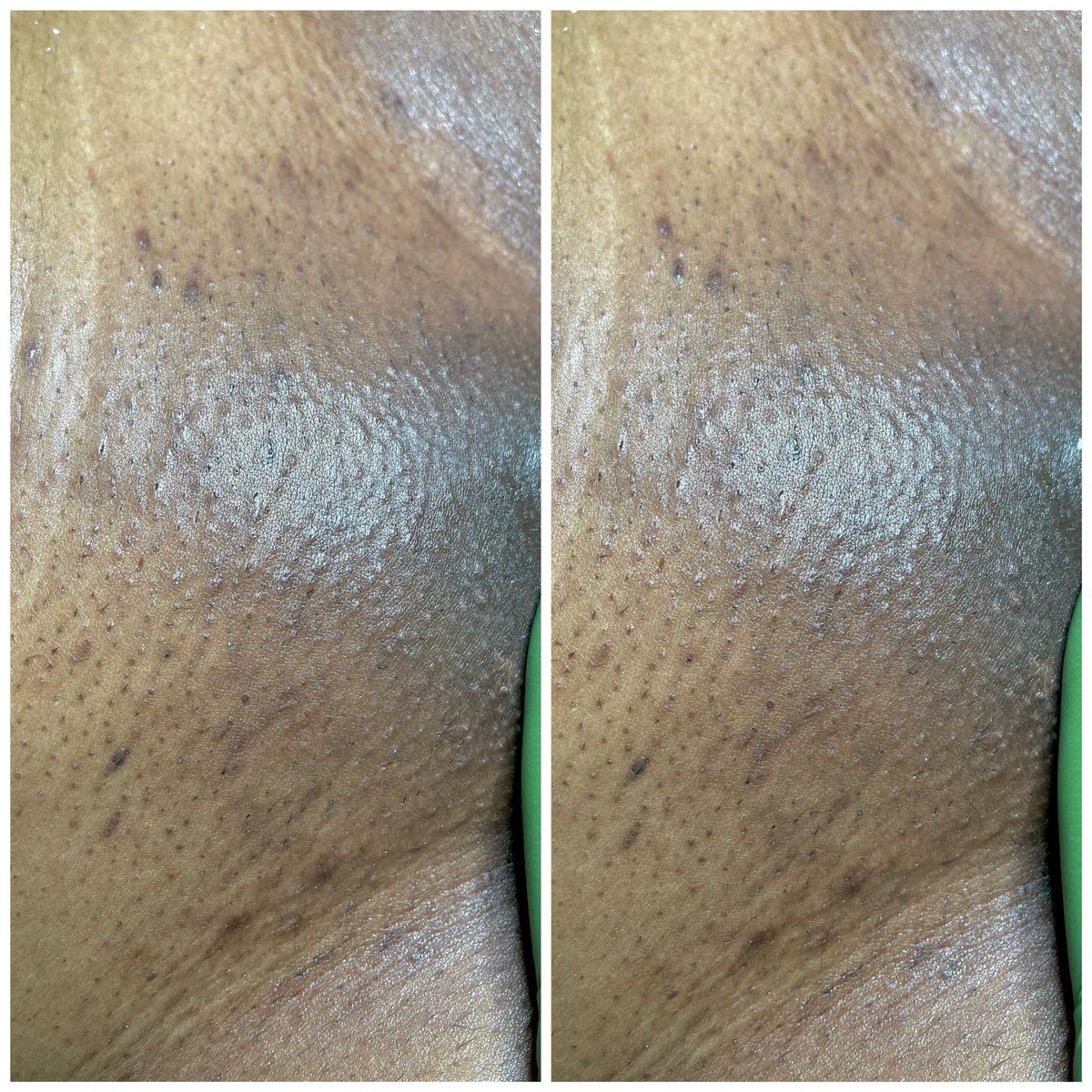 ✨Brazilian Wax✨

Still perfecting my craft (so not too much now) but we’re definitely getting better and faster! Come see me for all of your waxing needs! 💜