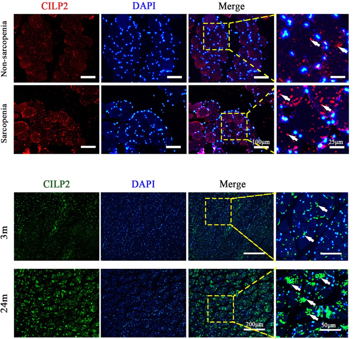 musclecellnews's tweet photo. 💭 How does CILP2 contribute to age-related #MuscleAtrophy?
Scientists found that CILP2 suppresses the Wnt/β-catenin signaling pathway, leading to impaired #insulin sensitivity and glucose metabolism in skeletal muscle.
📖 https://t.co/069cRU0mUm https://t.co/yQlT64pGc1