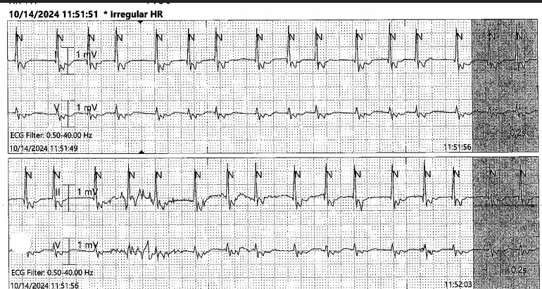 syamkumarmd's tweet photo. Irregular tachycardia. Mechanism? #Epeeps #Fellowsfirst https://t.co/bUSUnaG2Mo