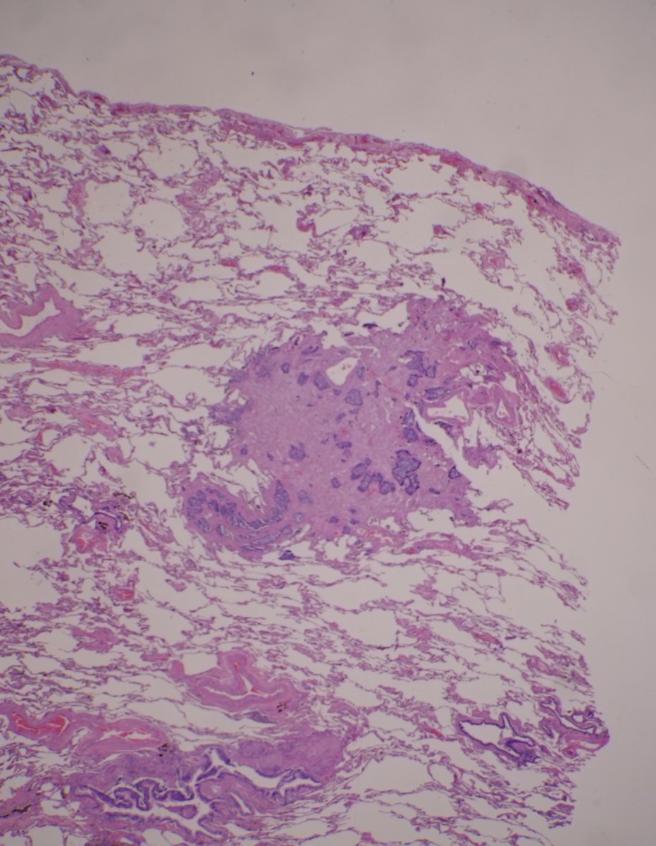 RFutoran's tweet image. 86 y/o with numerous bilateral nodules.  
#PathTwitter #pulmonarypath #surgpath