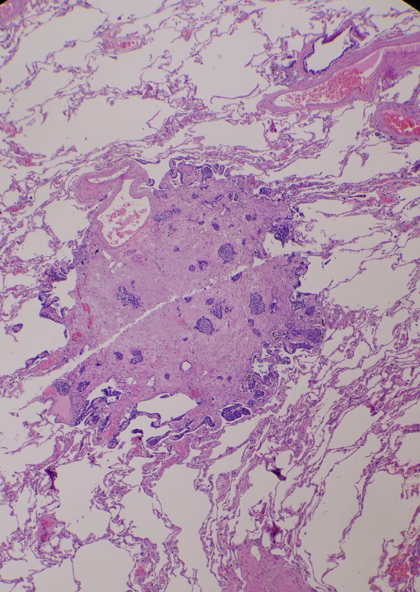 RFutoran's tweet image. 86 y/o with numerous bilateral nodules.  
#PathTwitter #pulmonarypath #surgpath