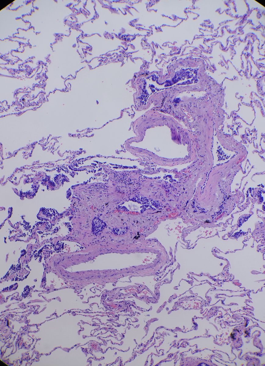 RFutoran's tweet image. 86 y/o with numerous bilateral nodules.  
#PathTwitter #pulmonarypath #surgpath