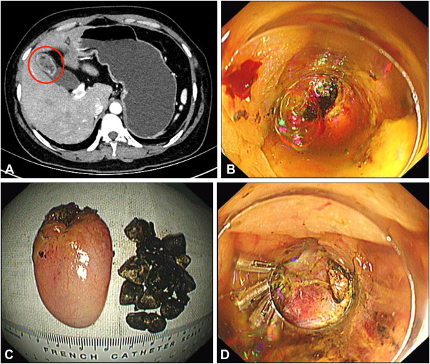 At the Focal Point, Liu et al perform "Natural orifice transluminal endoscopic surgery for partial cholecystectomy: first clinical practice (with video)." giejournal.org/article/S0016-…

#GITwitter #GIEJournal