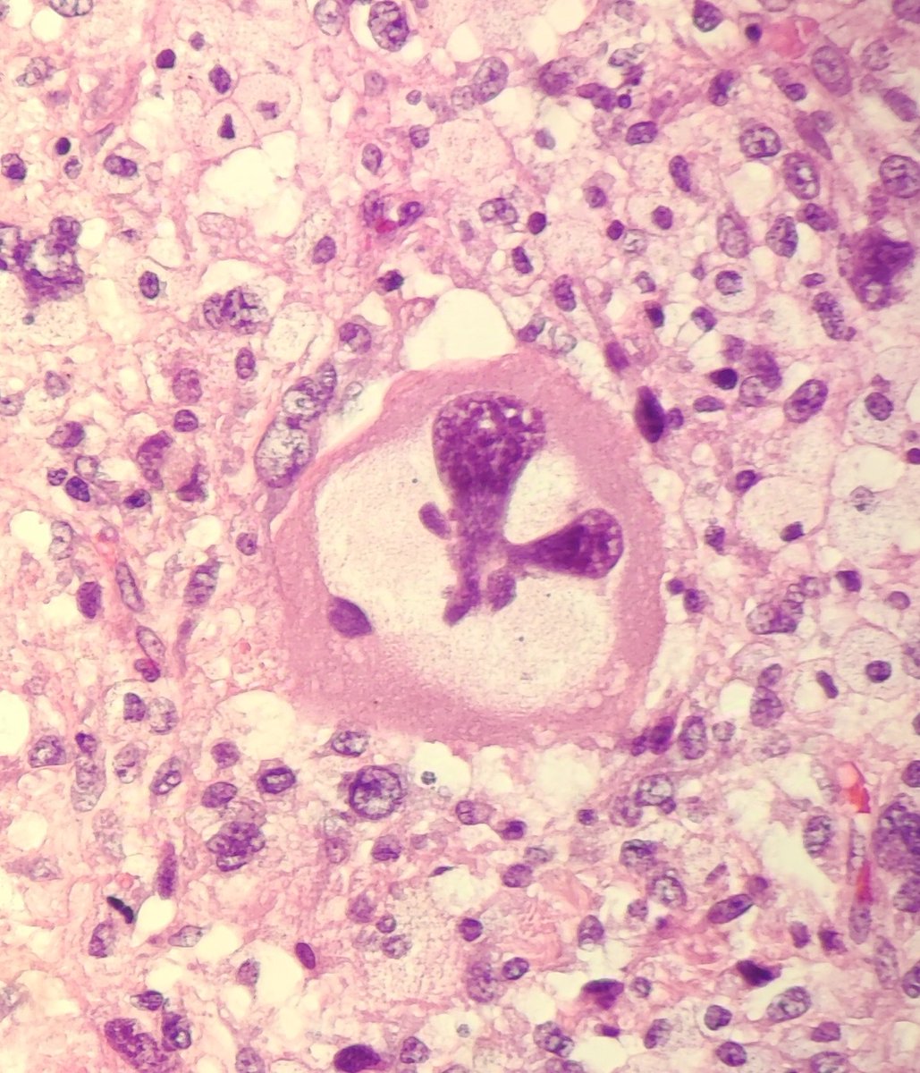 SBaksuz's tweet photo. It's three o'clock, go home. #pathology #histology #PathTwitter https://t.co/G6FtGvEPuF
