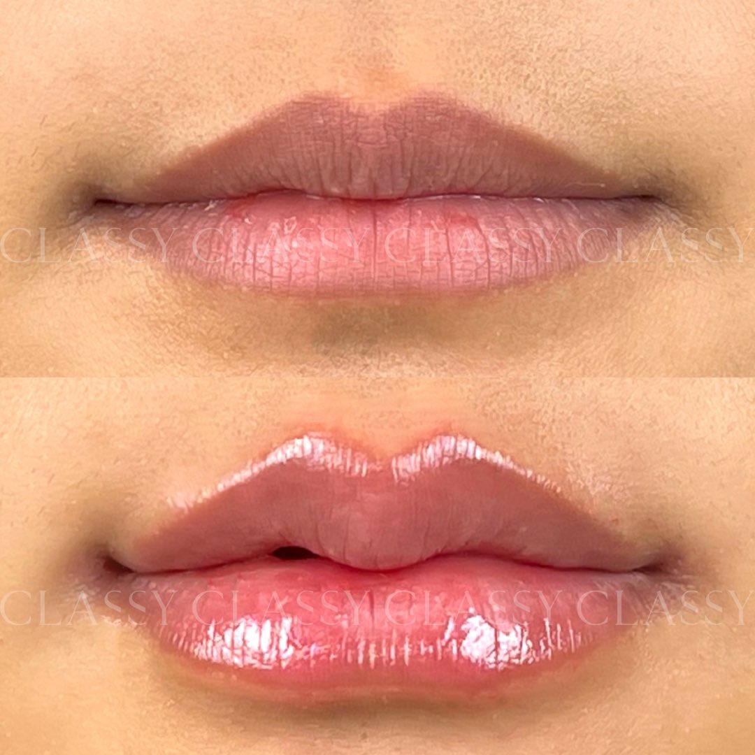 ClassyClinic's tweet photo. โปรแกรมฟิลเลอร์ปาก ที่ออกแบบเฉพาะบุคคลที่ Classy Clinic ✨

#fillerlips #ClassyLips #ClassyClinic https://t.co/KquRIizrTt