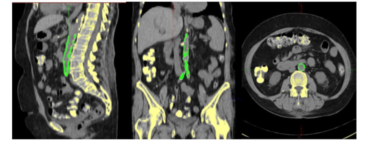 Our recent study, published in Nature Scientific Reports, reveals the critical role of Abdominal Arterial Calcification (AAC) in predicting mortality risk for kidney transplant patients using #ai 

nature.com/articles/s4159…