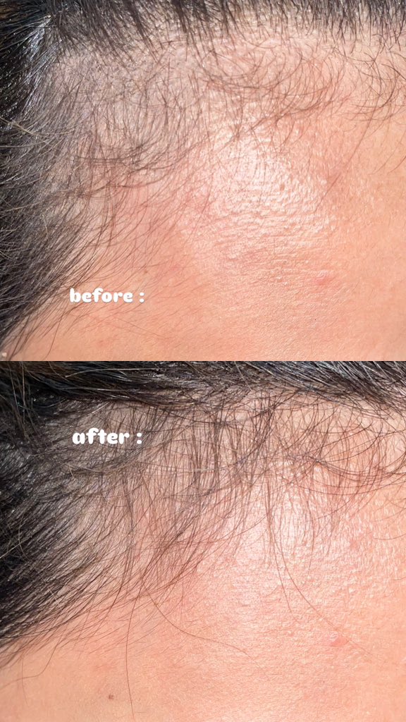 txtjane's tweet photo. PRODUKK PENYELAMAT YANG KALIAN WAJIB BGT TAU‼️🫵🏻

Sumpah ini ga lebay, tapi hair serum ini bener bener bagus dan ngaruh banget??!! baby hair aku jadi tumbuh lebat banget🫵🏻

#RacuninHairCare #ReAllignTheHairLone #LebatNoDebat https://t.co/1xwgdzN26t