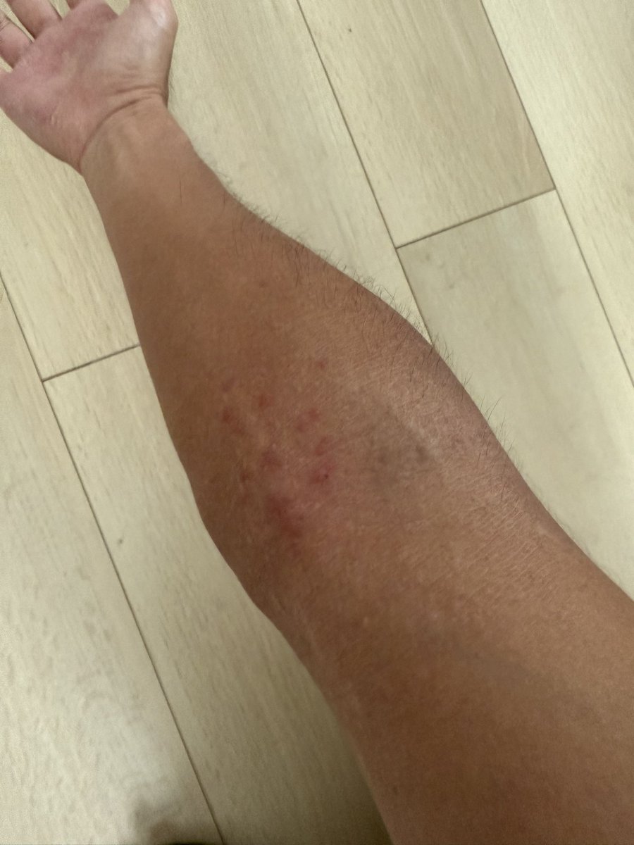 hiroppuuu's tweet photo. なんか急に赤いポツポツが。。。シーツ交換、部屋の換気、食事など、色々おろそかになってしまってた。もっかい生活見直さなあかん。。あとやっぱり夏より冬側のほうが、自分は悪化しやすいイメージ。やから夏の方が好き https://t.co/MgiEp1diaD