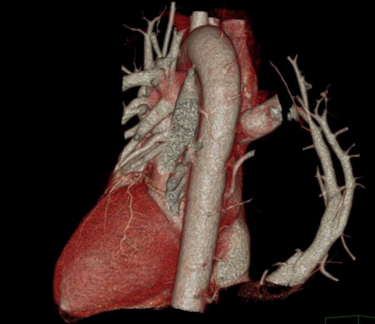 UICARicardiaca's tweet photo. 76 yo 👨🏼 
First symptom: AV nodal reentrat tachycardia 
 
Beautiful first diagnosis of Cimitarra Syndrome with right pulmonary veins draing into the dilated IVC #UICAR #yesCCT @Angi_RomeroMD #cardiac imagin https://t.co/GqlFqr3M2u