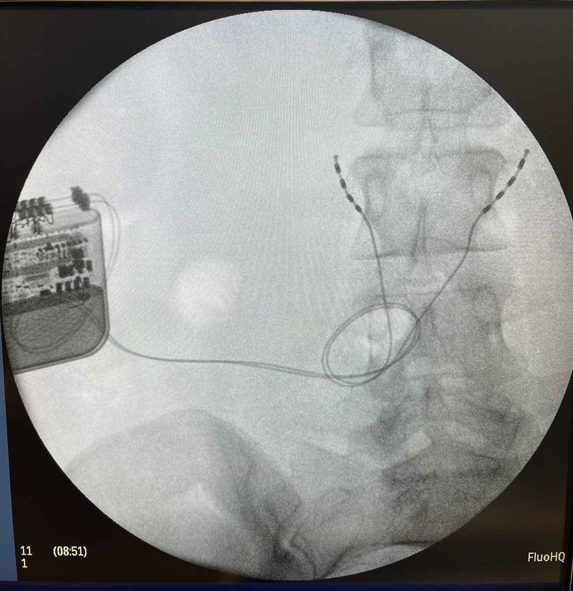 Glade Roper, MD - MSK/IR tweet media