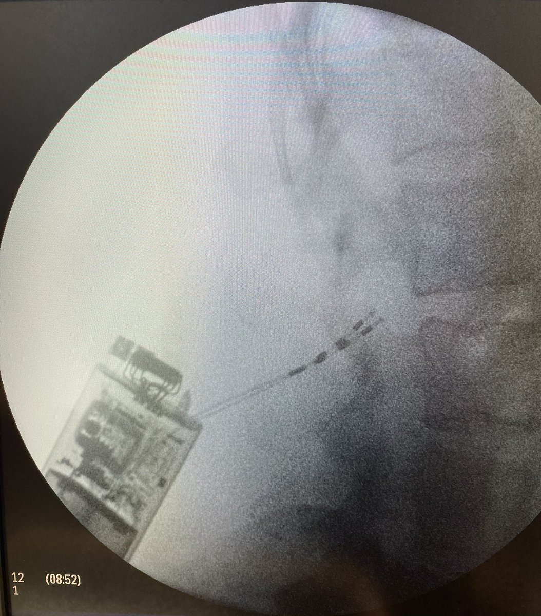 Glade Roper, MD - MSK/IR (@darthglader) on Twitter photo More #MSKIR in a woman in her 40s with chronic back pain. She has positive #PIT, arm raise, and toe touch tests. #MRI reveals multifidus atrophy.
#Reactiv8 from <a href="/MainstayMedical/">Mainstay Medical</a> implanted with picture perfect lead placement. Good multifidus activation at the lowest setting! More #MSKIR in a woman in her 40s with chronic back pain. She has positive #PIT, arm raise, and toe touch tests. #MRI reveals multifidus atrophy.
#Reactiv8 from <a href="/MainstayMedical/">Mainstay Medical</a> implanted with picture perfect lead placement. Good multifidus activation at the lowest setting!