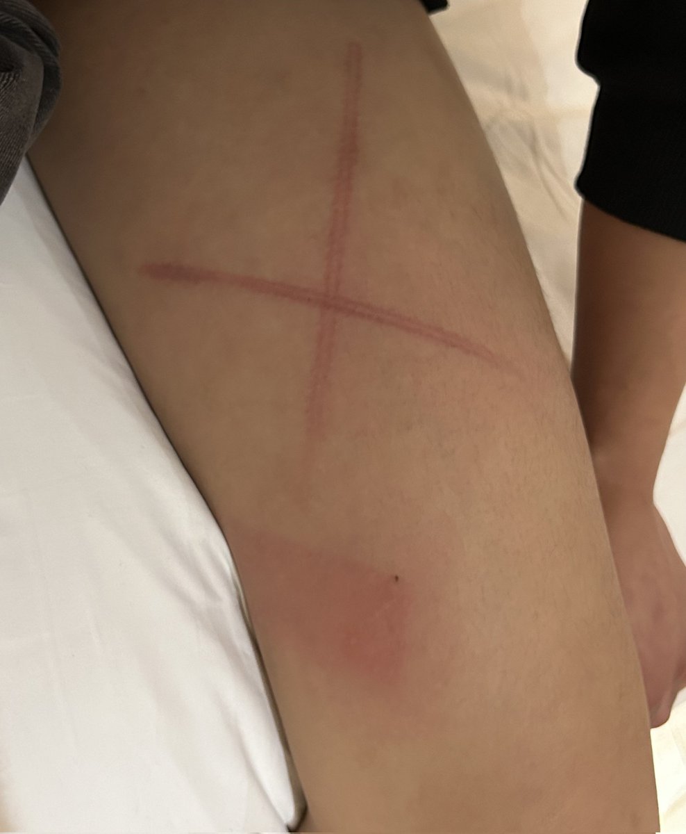 xixi_922's tweet photo. 最终还是藤条印深得我心 
#sp #spank #打屁股 #弟弟 #小圈 #小圈实践 https://t.co/93JuAj7J4b