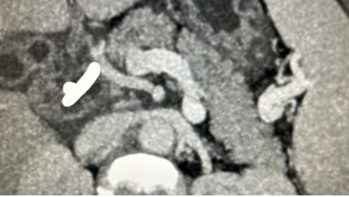 dr70ashu's tweet photo. Cha arising from sma. An injury during whipple may lead to liver ischemia. Any ways to prevent? @Shrikhande_SV @HoggNDMD https://t.co/D1eilrOYBX