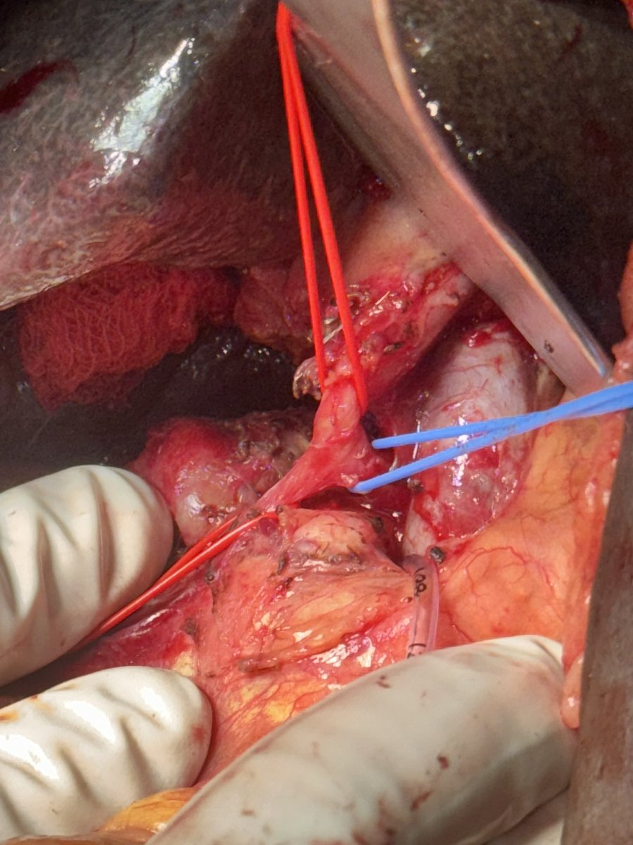 dr70ashu's tweet photo. Cha arising from sma. An injury during whipple may lead to liver ischemia. Any ways to prevent? @Shrikhande_SV @HoggNDMD https://t.co/D1eilrOYBX