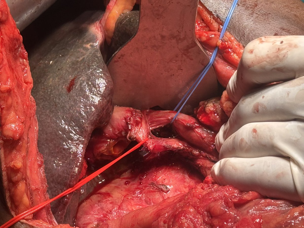 dr70ashu's tweet photo. Cha arising from sma. An injury during whipple may lead to liver ischemia. Any ways to prevent? @Shrikhande_SV @HoggNDMD https://t.co/D1eilrOYBX