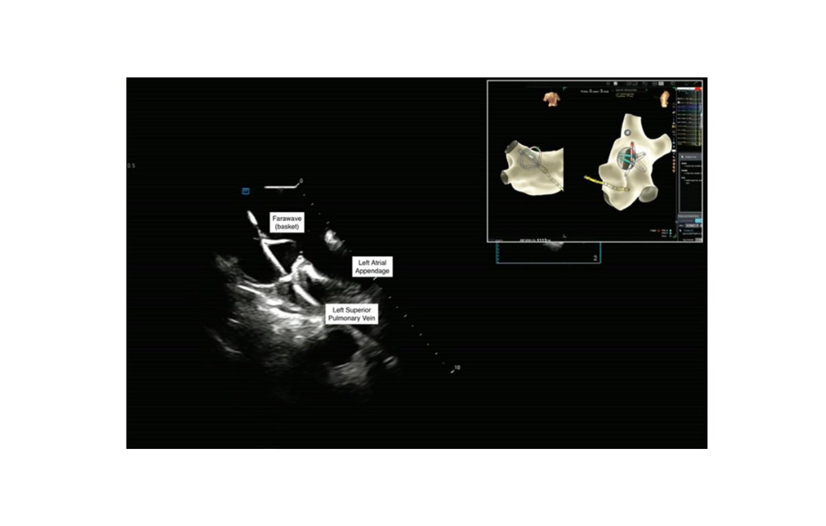 Case Study: Use of Left Atrial Intracardiac Echocardiography and Electroanatomic Mapping for a Zero-Fluoroscopy #PFA Workflow in Pulmonary Vein and Posterior Wall Isolation <a href="/EduardoSaad3/">Eduardo Saad</a> <a href="/RonukModi/">Ronuk Modi, MD</a>
okt.to/3knH1G #EPeeps