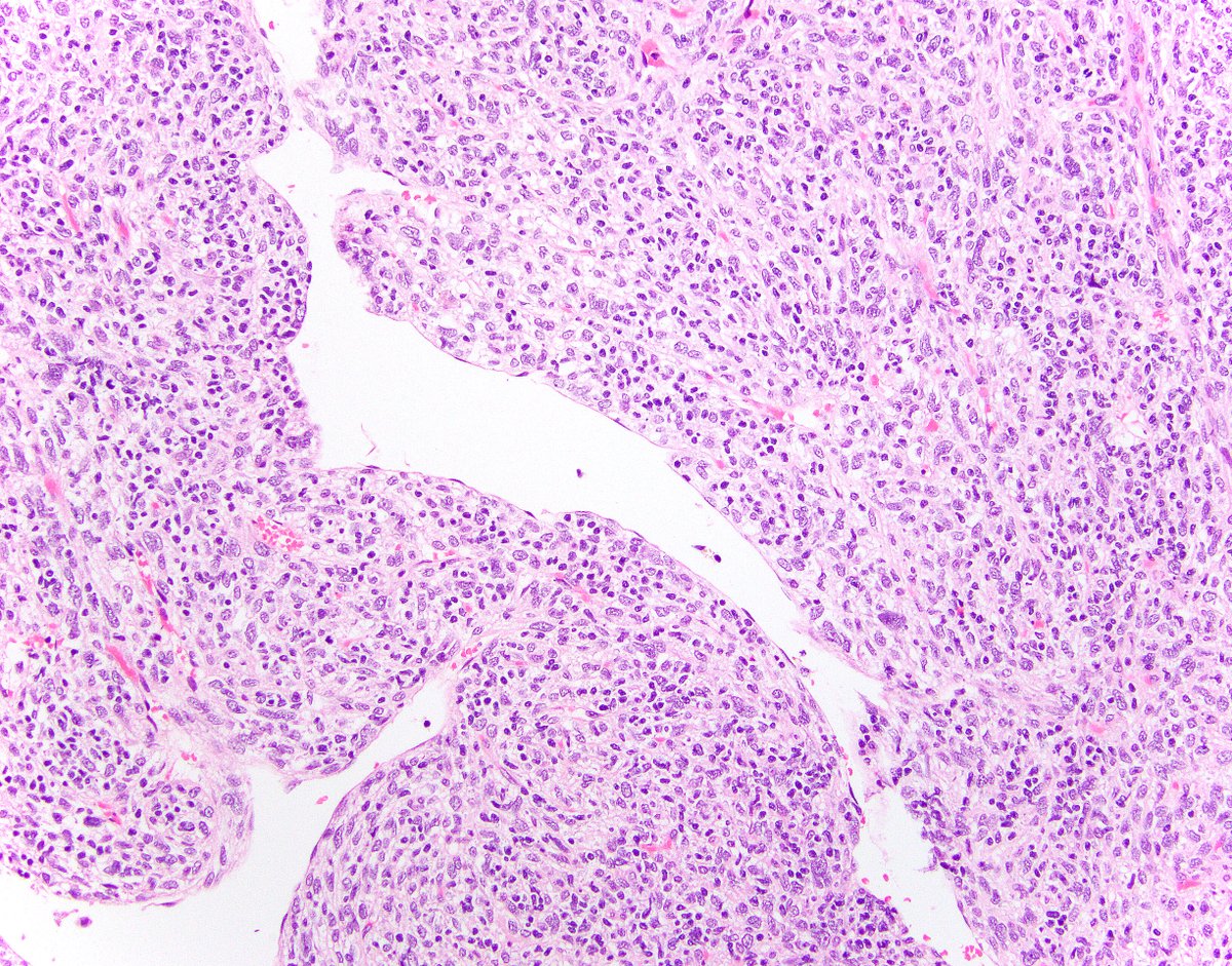 Clear Cell Stromal Tumor of Lung: A Clinicopathologic, Immunohistochemical, and Molecular Characterization of 8 Cases

@Odintsov_I <a href="/lmsholl/">Lynette Sholl</a> <a href="/AlexIsaacsonMD/">Alex Isaacson, MD</a> <a href="/KarenFritchieMD/">Karen Fritchie</a> <a href="/KhPooria/">Pooria Khoshnoodi</a>

#pulmpath #BSTPath

sciencedirect.com/science/articl…