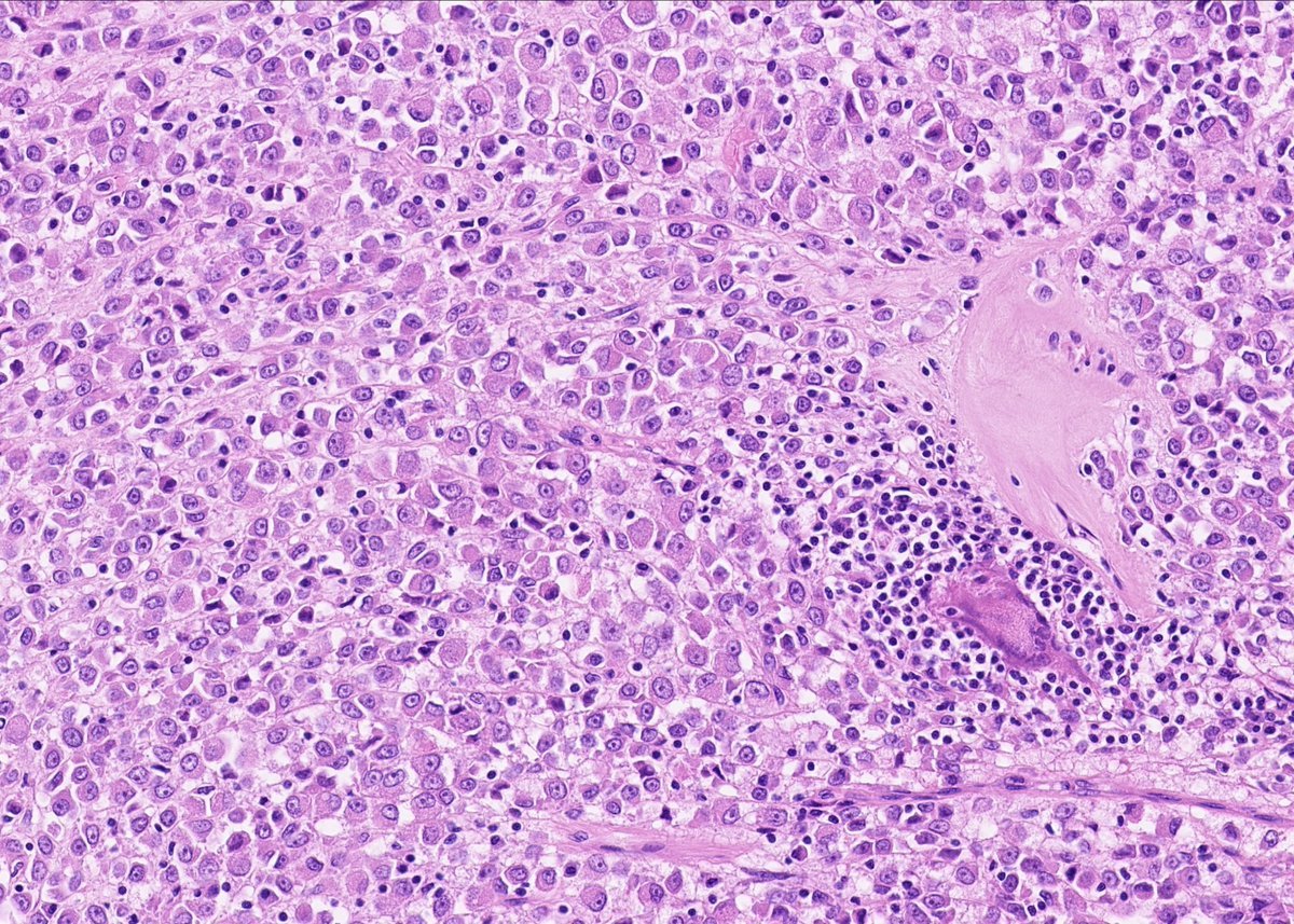 AliaksZhur's tweet photo. My first experience with NUT1-positive colorectal sarcoma
#GIpath #BSTpath #NUTM1 #NUT1 https://t.co/Ta5vj8Fxnj