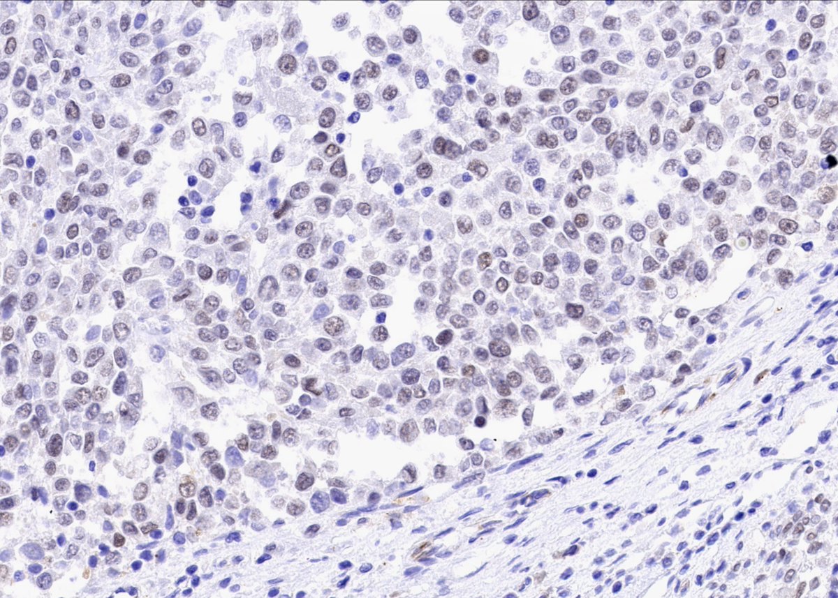 My first experience with NUT1-positive colorectal sarcoma
#GIpath #BSTpath #NUTM1 #NUT1
