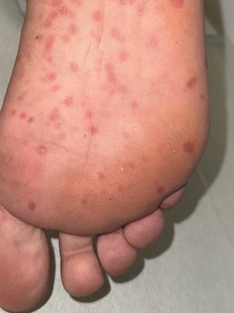 mig_yec's tweet photo. ¿Cuál es vuestra principal sospecha ante estas lesiones?
What is your first suspiction when you see this lesions?
#MIR #CaseChallenge
🤔🤷🏽♀️🤷
Aprovecho para animar a todos aquellos que andan con el #MIR y otros #IR ya queda menos 🙌🏼 https://t.co/Lypx5upEKM