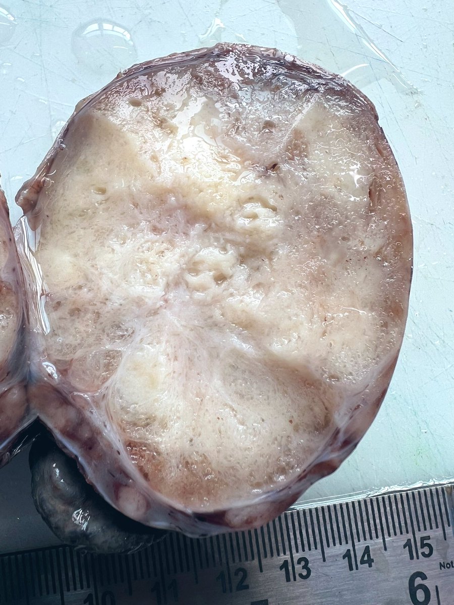 Immanuel_Paul30's tweet photo. ‘There is a certain majesty in simplicity which is far above all the quaintness of wit’
Thoughts 💭
#PathX #surgicalpath #pathtwitter https://t.co/zs98YZlOvo