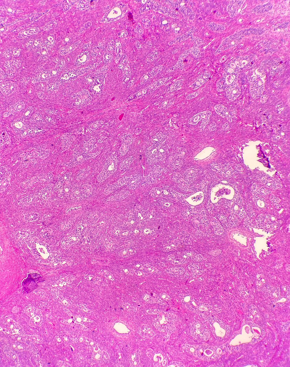 Vivi Fernandez (Dr. Autopsy) D.O. 🐈🐈⬛🌈🇨🇺 (@path_girl88) on Twitter photo Finishing this week by contrasting a Benign Brenner with a Borderline Brenner and a Malignant Brenner Tumor, of the ovary. 🤩 #gynpath #pathx #PathTwitter #UMiamipath <a href="/UMiamiPathology/">UMiami Pathology</a> Finishing this week by contrasting a Benign Brenner with a Borderline Brenner and a Malignant Brenner Tumor, of the ovary. 🤩 #gynpath #pathx #PathTwitter #UMiamipath <a href="/UMiamiPathology/">UMiami Pathology</a>