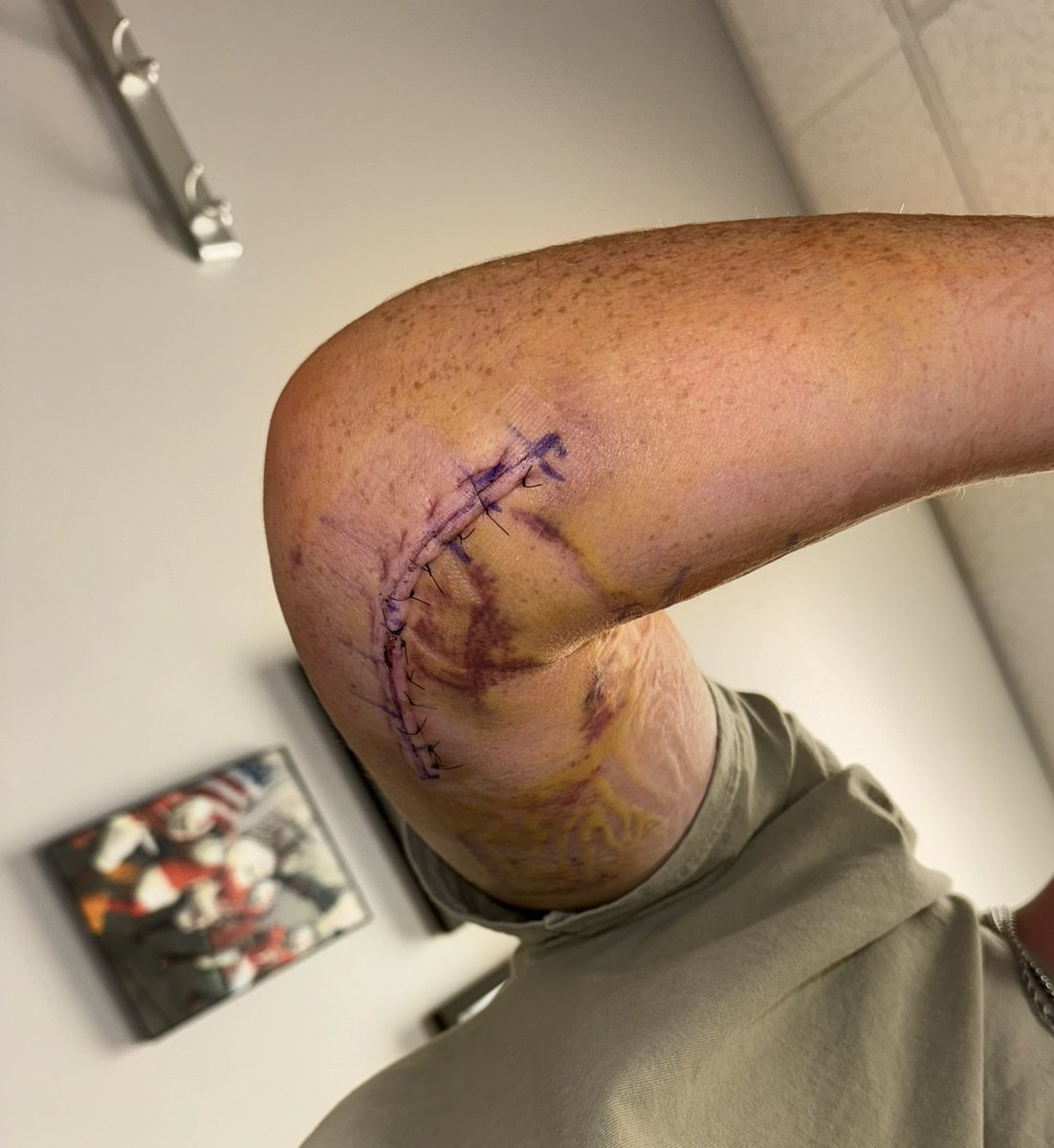 KellarDavis1's tweet photo. 9 days post-op Tommy John. God’s plan>mine. Ready for the comeback🦾 https://t.co/GfTGFfNGOw