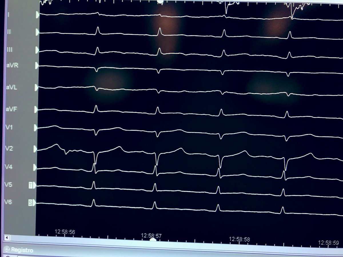 Dahyr Olivas MD (@elarritmiologo) on Twitter photo #EPeeps❕
after PFA PVI ParoxAF we had this inferolateral ST elevation
😰26 min AFTER last PFA shot!❗️⚠️🛑
Complete ST normalization with IV nitrate in 40 secs. No angiography
Toughts?
<a href="/cespon_maria/">María Cespón</a> <a href="/TomasDatino/">@TomasDatino</a> <a href="/Hapa_EP/">Kevin Brady</a> <a href="/jczerpa/">JC ZERPA</a> <a href="/jongichun/">Julian Chun</a> <a href="/SergeBoveda/">Serge Boveda</a> <a href="/joselmerino/">Jose Luis Merino</a> <a href="/ALFIEEP1/">ALBERTO ALFIE</a> #EPeeps❕
after PFA PVI ParoxAF we had this inferolateral ST elevation
😰26 min AFTER last PFA shot!❗️⚠️🛑
Complete ST normalization with IV nitrate in 40 secs. No angiography
Toughts?
<a href="/cespon_maria/">María Cespón</a> <a href="/TomasDatino/">@TomasDatino</a> <a href="/Hapa_EP/">Kevin Brady</a> <a href="/jczerpa/">JC ZERPA</a> <a href="/jongichun/">Julian Chun</a> <a href="/SergeBoveda/">Serge Boveda</a> <a href="/joselmerino/">Jose Luis Merino</a> <a href="/ALFIEEP1/">ALBERTO ALFIE</a>