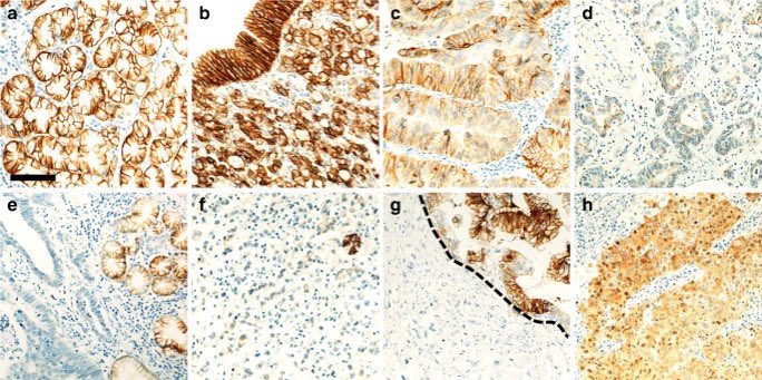 pashtoonkasi's tweet photo. 👇🏽One more option for our patients. Friday afternoon approval.✔️

Another upper GI biomarker to add to the list of things to 👀 test for.
💡All IHC🔬based
1️⃣HER2
2️⃣MMR
3️⃣CPS-PDL1
4️⃣ #CLAUDIN 18.2 (#CLDN18.2) ✅
5️⃣ FGFR2

#PrecisionMedicine 🎯 @OncoAlert https://t.co/GTj0P3TYNp