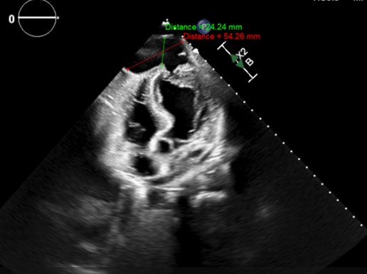 Jason N. Johnson, MD MHS (@jason_n_johnson) on Twitter photo 👨18 yo male w/ recurrent venous thromboembolism
🚗8 m/o prior chest trauma from MVA→Trop↑→POC US chest nml→CT nml→left AMA
✅Now, 2 wk hx of dyspnea
✅Self reported myocarditis 2 m/o prior
#echofirst →large LV aneurysm vs pseudo
☢️Chest CT →LV pseudo
2/6
#whyCMR <a href="/SCMRorg/">Society for Cardiovascular Magnetic Resonance</a> 👨18 yo male w/ recurrent venous thromboembolism
🚗8 m/o prior chest trauma from MVA→Trop↑→POC US chest nml→CT nml→left AMA
✅Now, 2 wk hx of dyspnea
✅Self reported myocarditis 2 m/o prior
#echofirst →large LV aneurysm vs pseudo
☢️Chest CT →LV pseudo
2/6
#whyCMR <a href="/SCMRorg/">Society for Cardiovascular Magnetic Resonance</a>