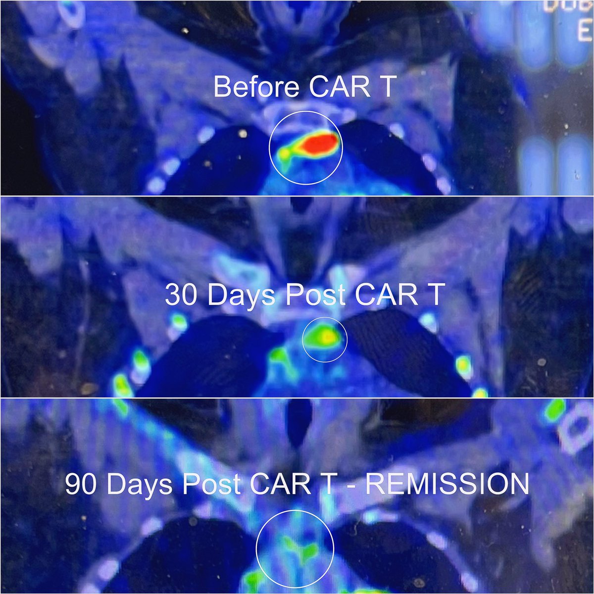 p_zoee's tweet photo. Finally Cancer Free after 2 years - cancer in pregnancy case. Refactory Primary Mediastinal NH Lymphoma. Failed RCHOP, Proton Therapy, Nivo &amp; Brentuximab, P-RICE. CAR T Cell Therapy did it! Thank you to @graham74GC for being the best consultant once I was under his care🎗️🤍 https://t.co/JowpcuFh4O