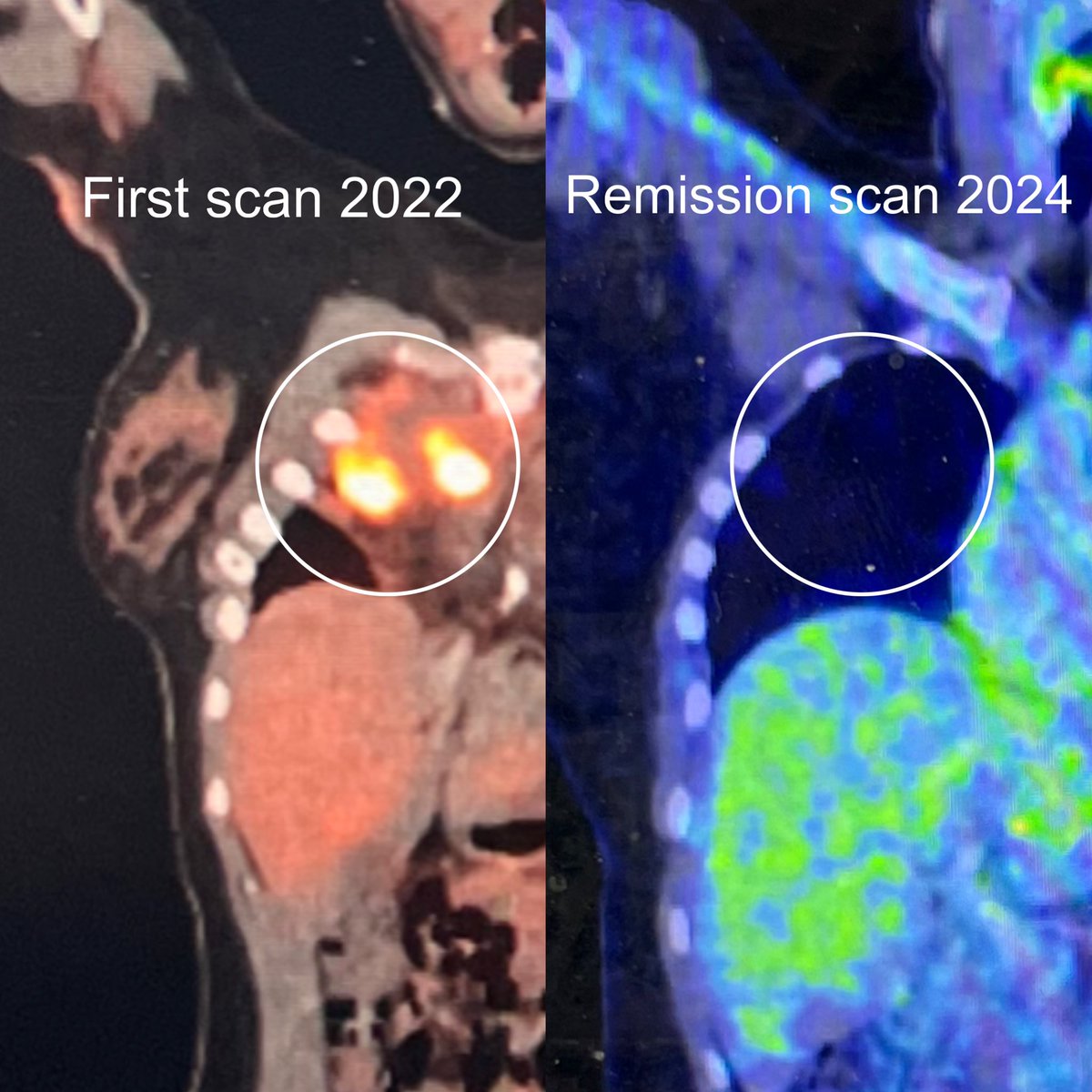 p_zoee's tweet photo. Finally Cancer Free after 2 years - cancer in pregnancy case. Refactory Primary Mediastinal NH Lymphoma. Failed RCHOP, Proton Therapy, Nivo &amp; Brentuximab, P-RICE. CAR T Cell Therapy did it! Thank you to @graham74GC for being the best consultant once I was under his care🎗️🤍 https://t.co/JowpcuFh4O