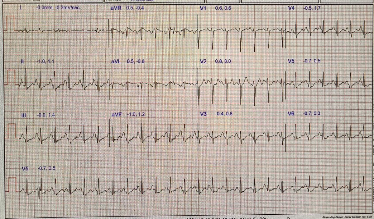 Less_is_More_MD's tweet image. 39 female on stress test for CP, healthy looking, no syncope shows this - thoughts ?
