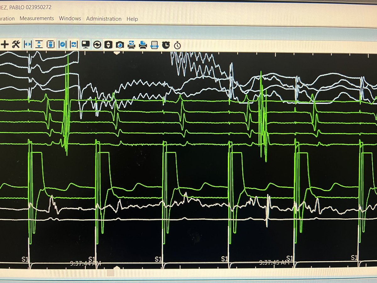 Nilesh Mathuria (@nileshmathuria) on Twitter photo Hey #EPeeps. Wonder how many cases like below will be missed in current #PFA era for #ablateAF. Pt with PAF with no prior h/o SVT and planned PVI with PFA.
Kudos to <a href="/HRSonline/">Heart Rhythm Society</a> for advocating EP study/endpoints for AF ablation Hey #EPeeps. Wonder how many cases like below will be missed in current #PFA era for #ablateAF. Pt with PAF with no prior h/o SVT and planned PVI with PFA.
Kudos to <a href="/HRSonline/">Heart Rhythm Society</a> for advocating EP study/endpoints for AF ablation