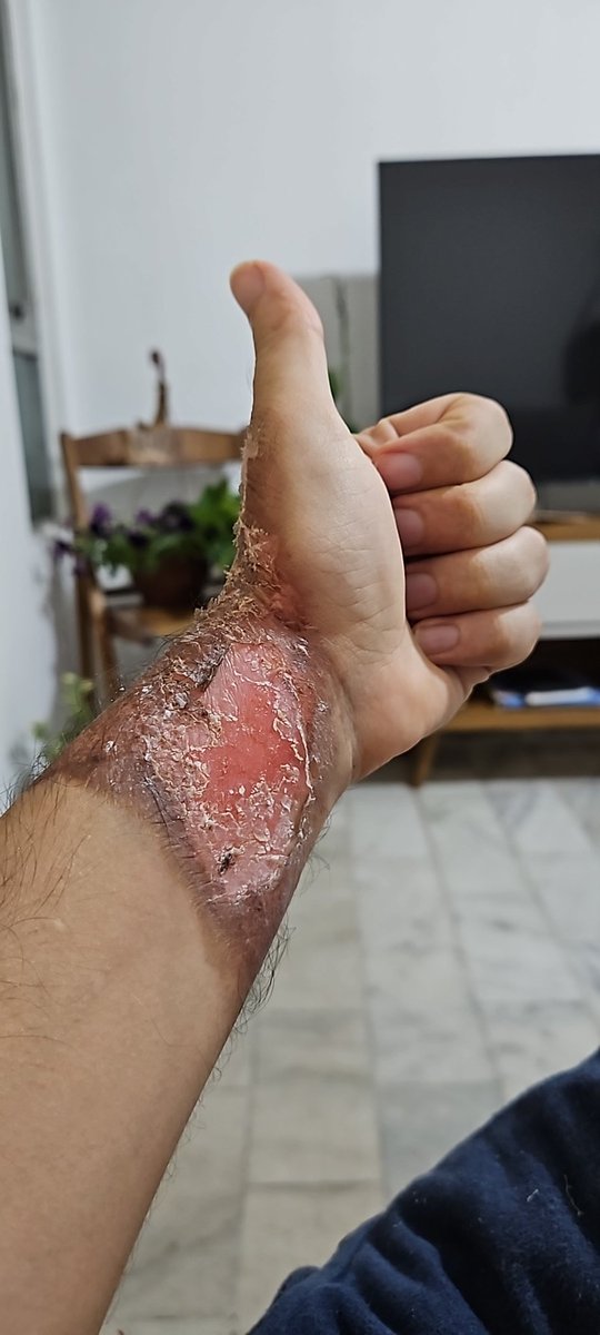 Queimei o braço, gostaram?