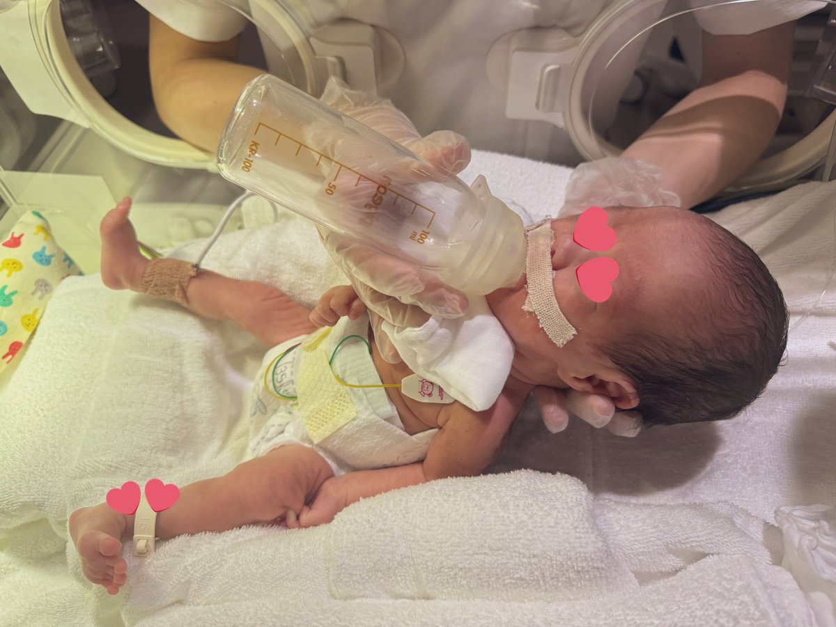 35w6d
1714g
ミルク30ml✖️8回
うち15mlは経口！！🍼
CPAP外して安定
未熟児網膜症発症なし
もうすぐGCU！！
#超低体重出生児