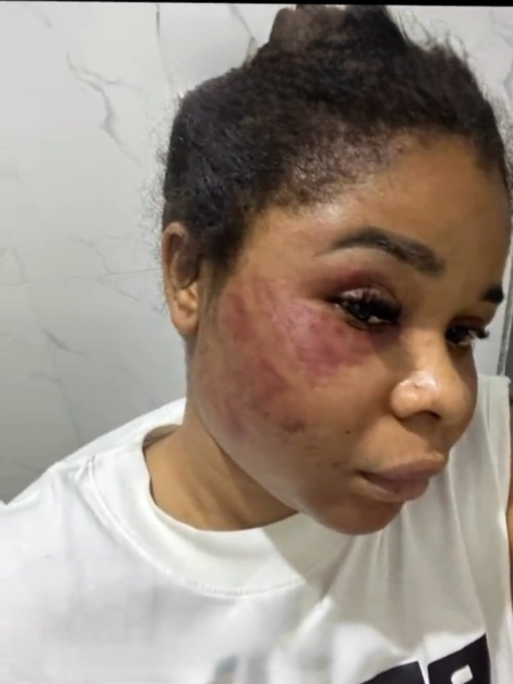 Drweloveu's tweet image. Lady shows off bruises from an abusive Boyfriend but claims he only hurts her because he smokes 🚬 

– full details in thread ●