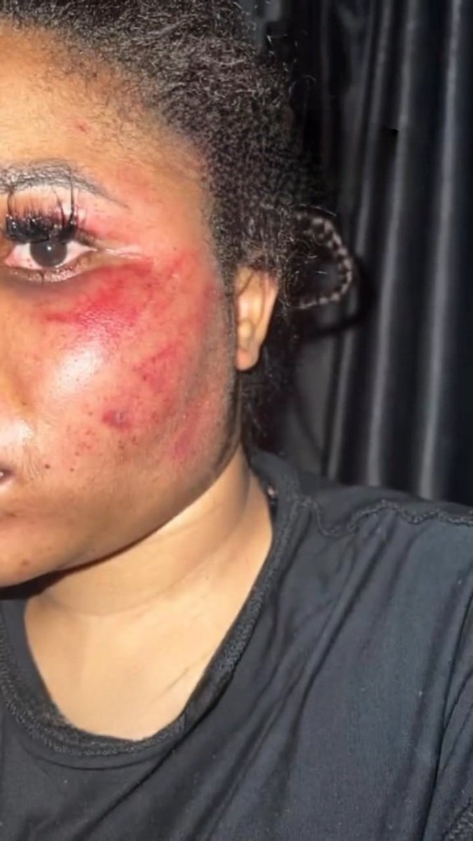 Drweloveu's tweet image. Lady shows off bruises from an abusive Boyfriend but claims he only hurts her because he smokes 🚬 

– full details in thread ●