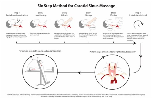 J_Francisco_EP's tweet photo. ⚠️Carotid Sinus Massage in clinical practice: the Six-Step-Method✅#EPeeps #Cardiology #CardioTwitter #syncope #EP
https://t.co/FI3TzRQT2i https://t.co/o2DwcjnU57