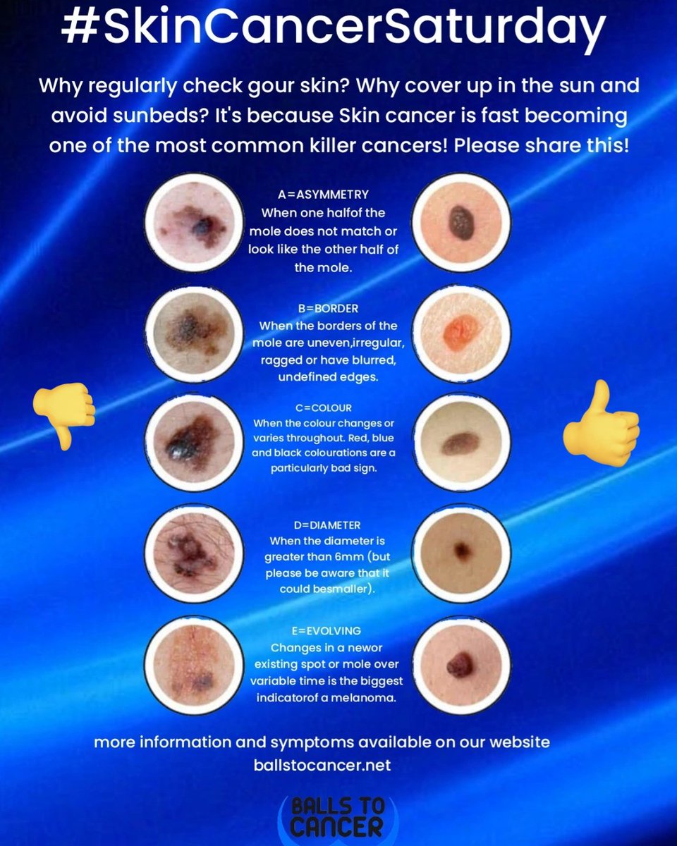 Ballstocancer's tweet photo. It's #SkinCancer Saturday. The summer my have gone but moles and marks on your skin are still something you need to keep and eye on and get someone to check your back ! These things have a habit of creeping up on you and small enough to ignore but please DON'T catching any cancer early increases your chances of survival. More details on our website #Checkit #Getitchecked #moles #cancer #CancerSupportCharity #cancerawareness