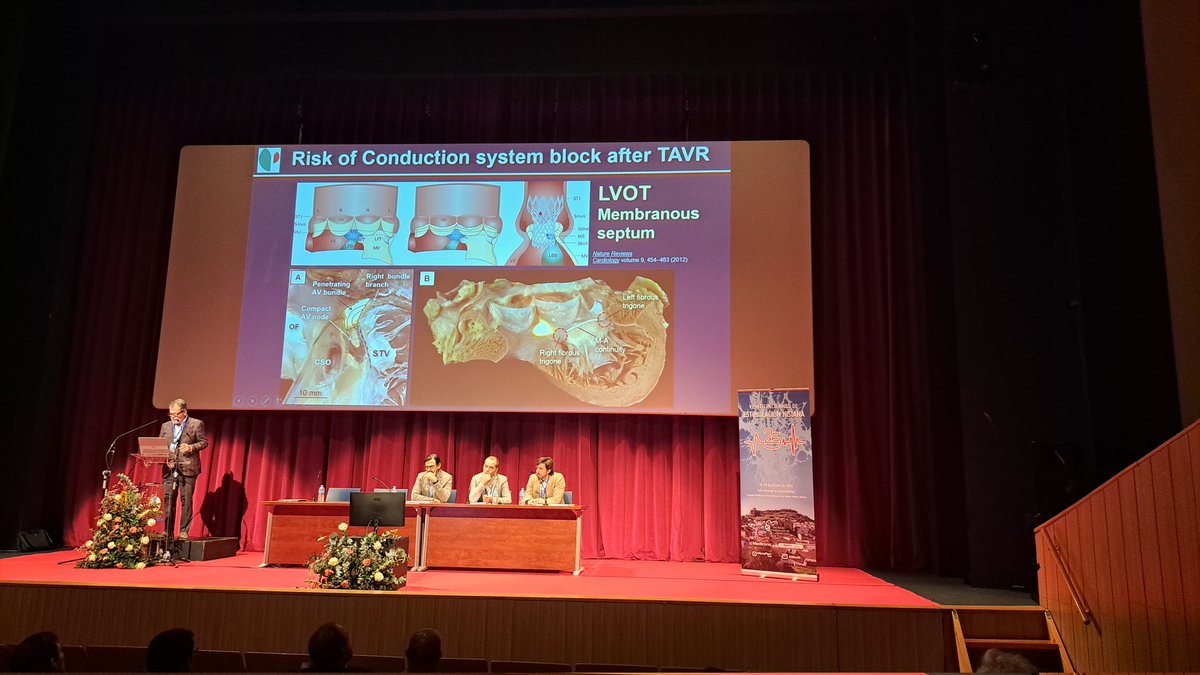 Teresa_Moraleda (@teremoraleda) on Twitter photo Excellent presentation of anatomical approach of conduction system pacing by <a href="/jacabreracardio/">Dr. José Ángel Cabrera</a>. <a href="/Dr_Pmorina/">Dr. Pablo Moriña Vázquez</a> <a href="/josemig_carreno/">José Miguel Carreño Lineros</a> <a href="/Irene_Esteve/">Irene Esteve</a> Excellent presentation of anatomical approach of conduction system pacing by <a href="/jacabreracardio/">Dr. José Ángel Cabrera</a>. <a href="/Dr_Pmorina/">Dr. Pablo Moriña Vázquez</a> <a href="/josemig_carreno/">José Miguel Carreño Lineros</a> <a href="/Irene_Esteve/">Irene Esteve</a>