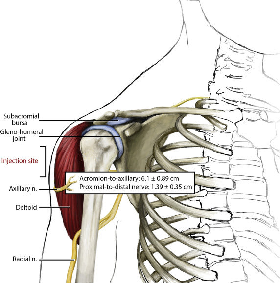 Omid_HopeUni's tweet image. Shoulder Injury Related to Vaccine Administration

✅shoulder capsule 👉🏼synovitis/infection
✅rotator cuff 👉🏼tendonitis/tear
✅subacromial/subdeltoid space👉🏼bursitis/frozen shoulder 
✅axillary nerve👉🏼numbnessl, temporary anterior/middle deltoid paralysis

jhsgo.org/article/S2589-…