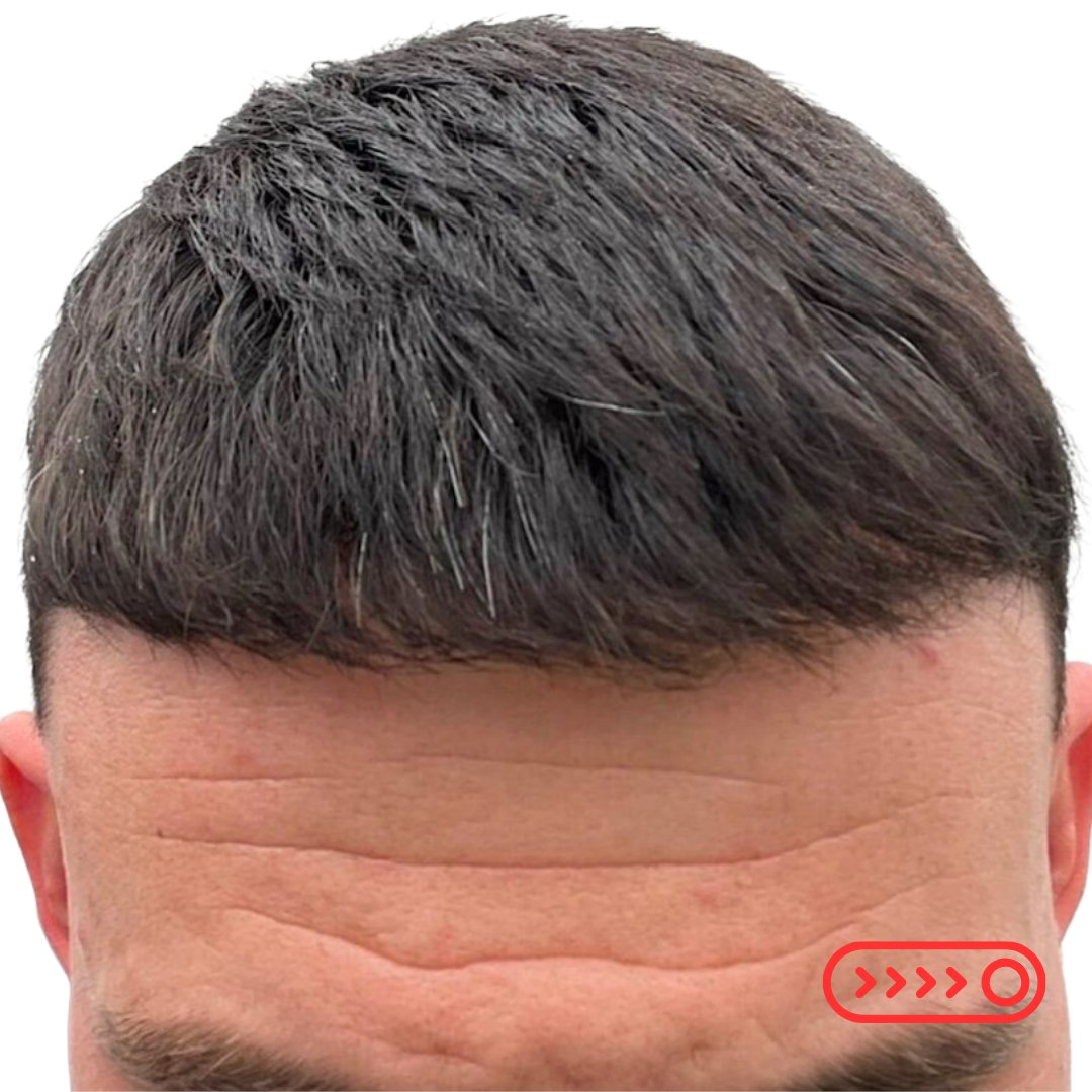 BHRClinic's tweet photo. https://t.co/M1YdGlNkjq

Signs Of 💯 Confidence: Showing Your Hair Transplant Results At 5 Months And In Natural Sunlight!☀️

#BHRClinic #FUESurgery #DrBisanga #HairRestoration #DrKostis #DrAbby #NaturalHairlines #DonorPreservation #HairTransplants #HairTransplantation https://t.co/ugIXeXTylQ