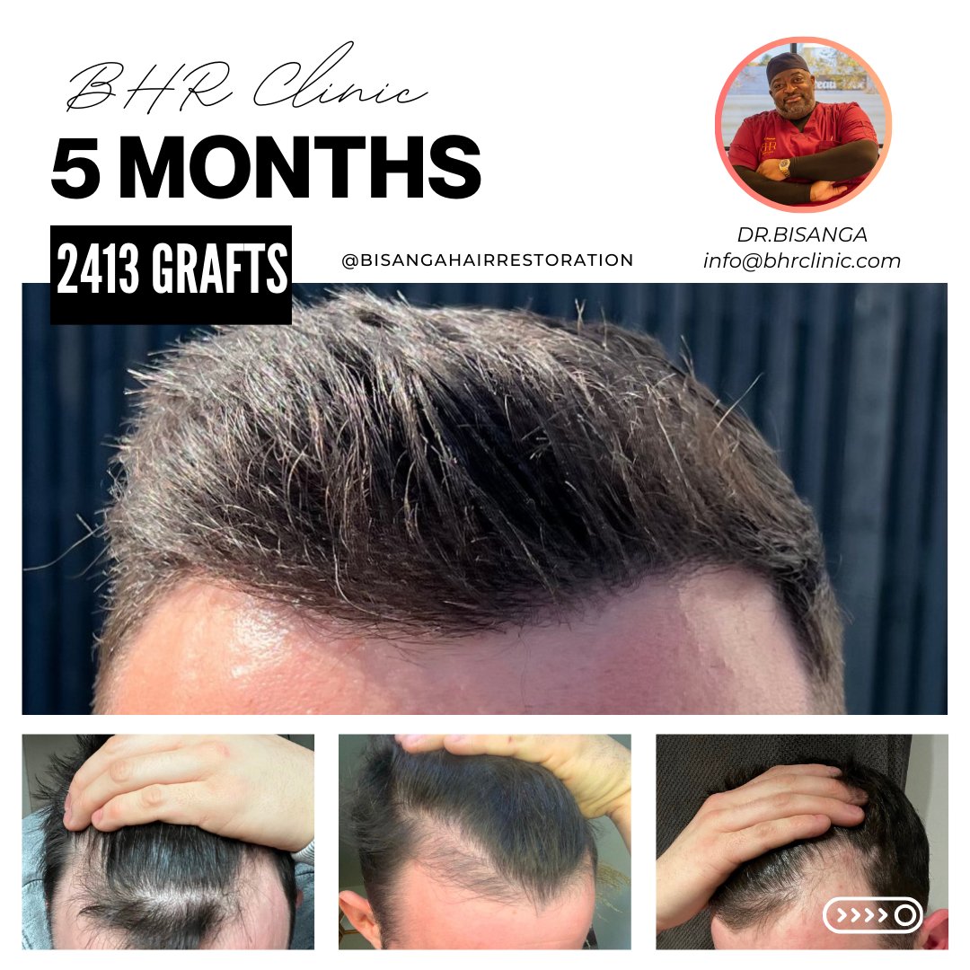 BHRClinic's tweet photo. https://t.co/M1YdGlNkjq

Signs Of 💯 Confidence: Showing Your Hair Transplant Results At 5 Months And In Natural Sunlight!☀️

#BHRClinic #FUESurgery #DrBisanga #HairRestoration #DrKostis #DrAbby #NaturalHairlines #DonorPreservation #HairTransplants #HairTransplantation https://t.co/ugIXeXTylQ