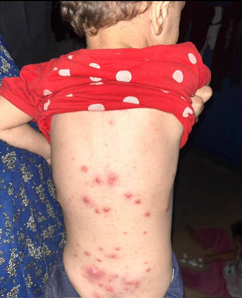 DONT SCROLLING PLEASE , I BEG U

The infection spread throughout
 Nimir's baby girls entire body Namir needs to get her kids out of g@za please help them ASAP
THEIR TREATMENT IS NOT WORKING AND THE WEATHER IS MAKING IT WORSE
 
HELP ME GET TREATMENT
gofund.me/79a3c1ad

#BB26