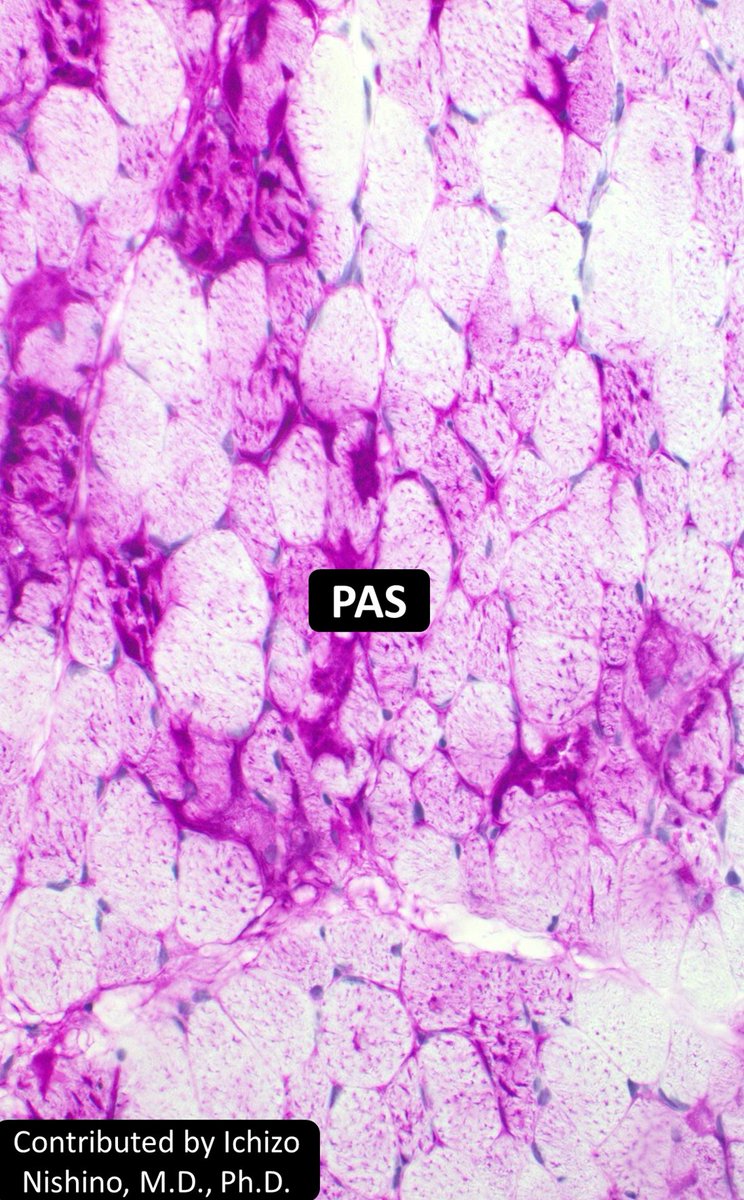 DrCycloPath's tweet photo. Muscle from a 5-month-old with cardiomyopathy & diffuse hypotonia, diagnosis?
A) Lysosomal disorder
B) Mitochondrial disorder
#BSTPath #PathTwitter #Pathology #PediPath