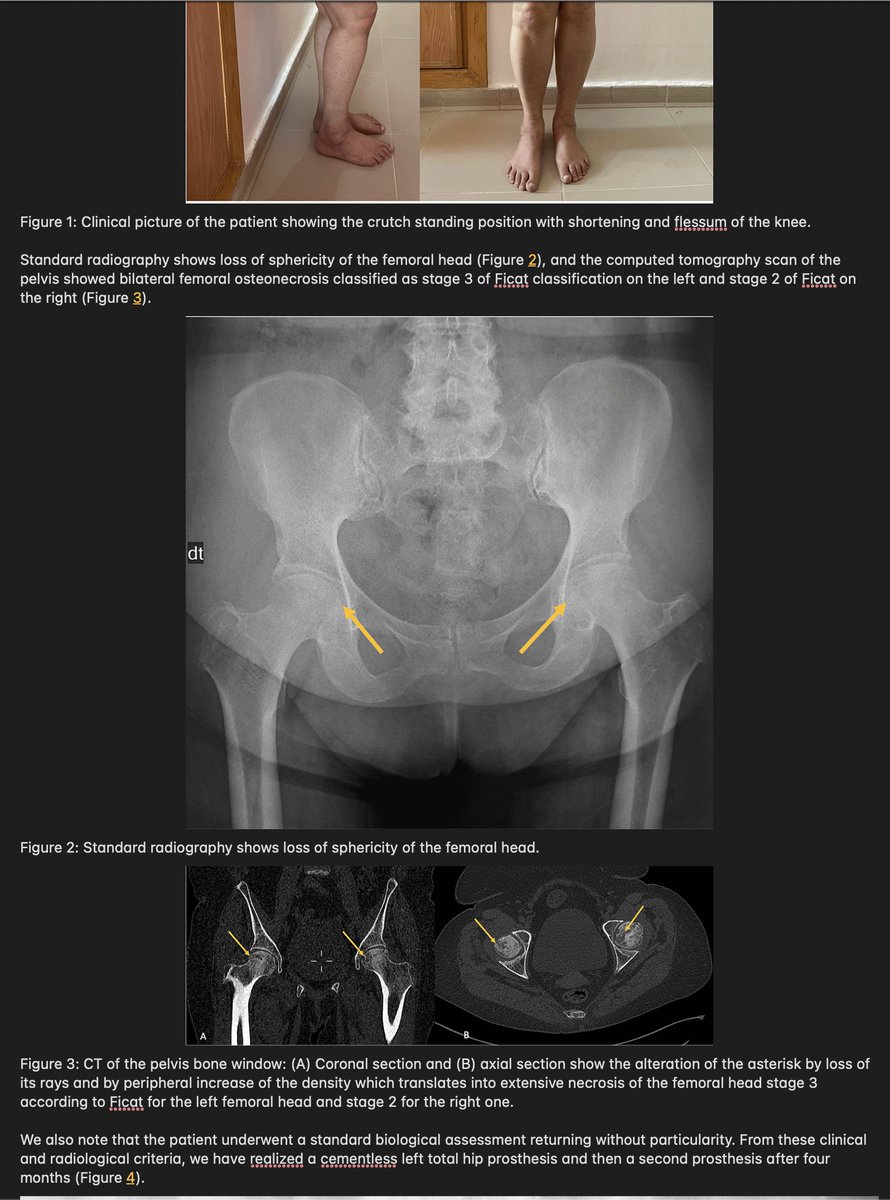 MarcusFitzsimon's tweet image. the FIRST thing I did in 2020 once it was named was look up its &quot;parent&quot;

every day I log in, I get angry

every day there&apos;s ANOTHER research article that simply RECONFIRMS what I knew in 2020

ALL SARS-COV-1 survivors suffered osteoporosis &amp;amp; necrosis of the femoral head