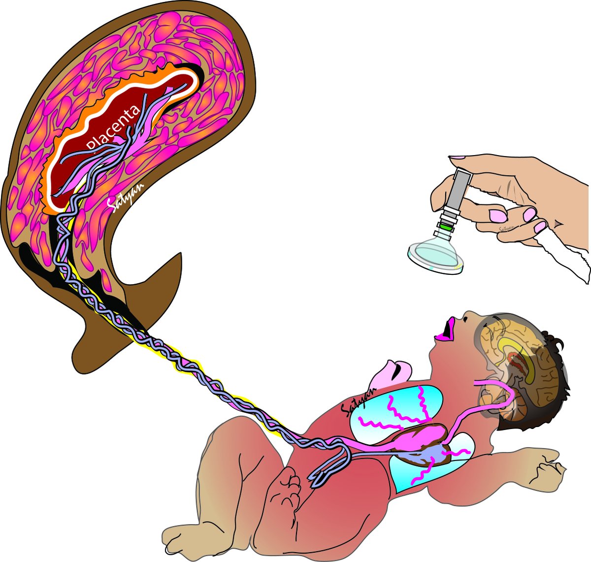 neosatyan's tweet photo. @AAPneonatal  and #Neotwitter - Second installment of weekend #Neographic - Delayed cord clamping and placental transfusion for your PowerPoint slides; @NeoAnup @cordclamping @WomenNeo @songMD - if you have specific requests for #neographic let me know @UCDavisChildren https://t.co/uYPIL0LZJY
