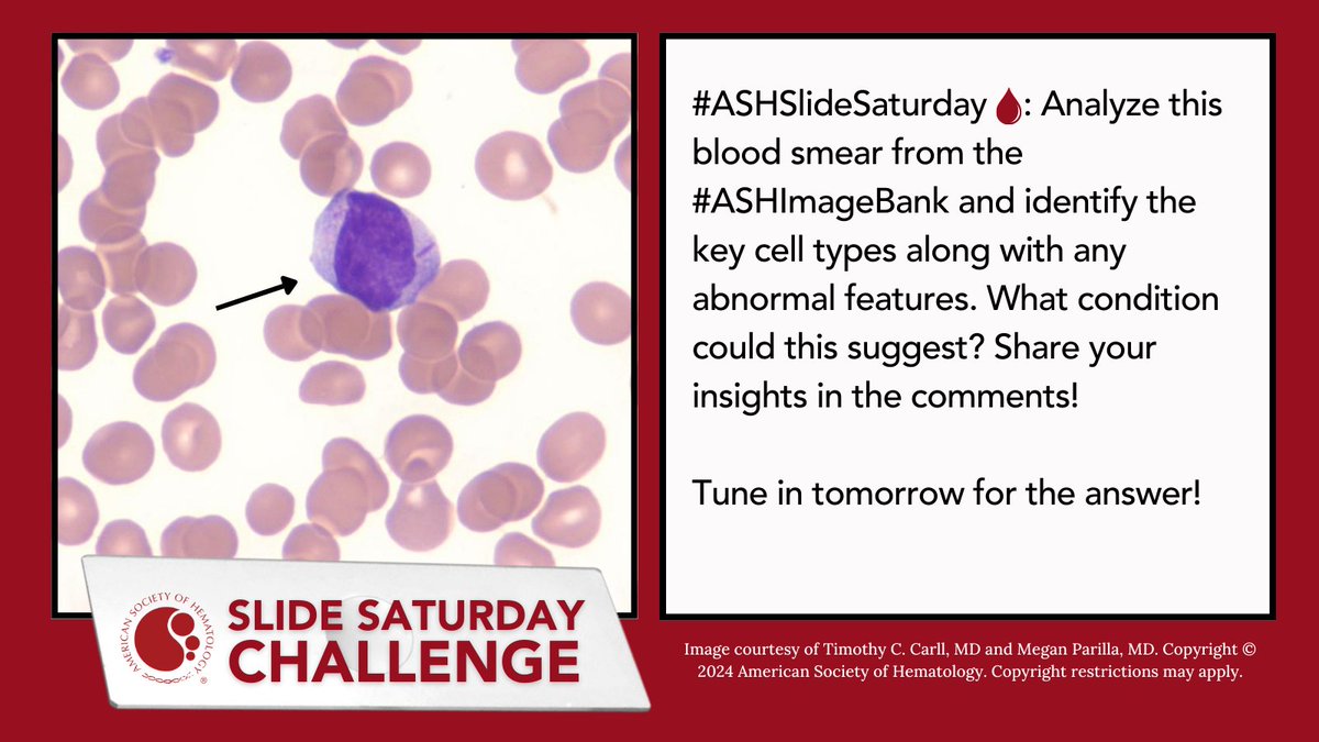 ASH_hematology's tweet photo. 🩸#ASHSlideSaturday - Analyze this blood smear from the #ASHImageBank and share your insights in the comments! 

#ASHEducation #Microlearning #Microscopy #ImageChallenge #Hematology #Hematopathology #ASHTrainee #LearningIsFun #KnowledgeIsPower #LearnGrowEvolve https://t.co/wXWvSTPHpt