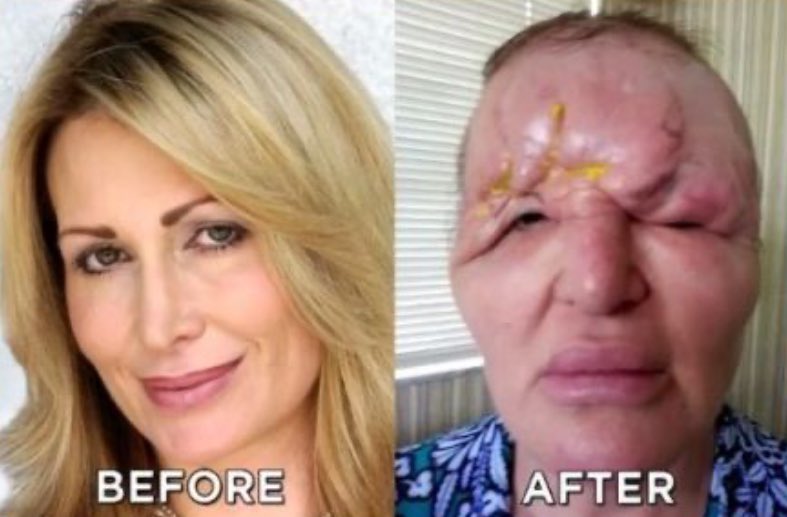 In 2009, Carol Bryan from Florida received facial fillers that were  mistakenly injected into the wrong area, causing her forehead to swell so  severely she had to tape her eyes open to